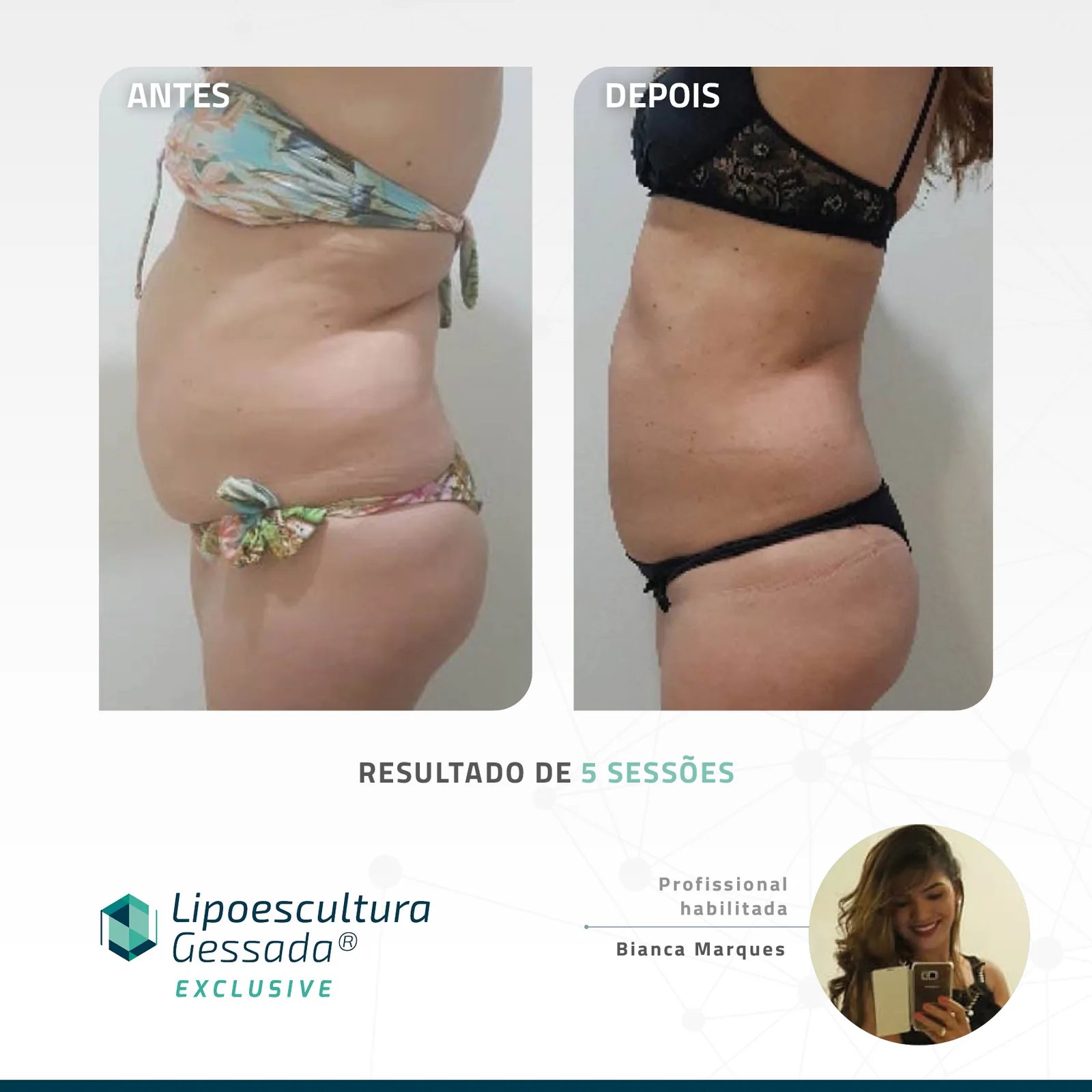 Antes e depois — celulite e gordura localizada por profissional habilitada