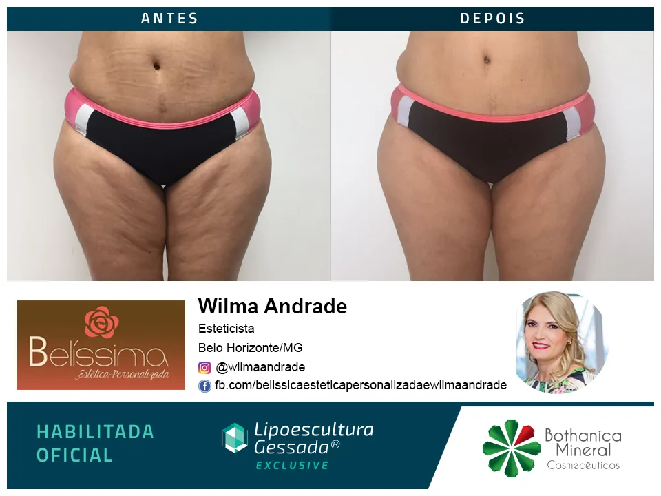 Antes e depois — celulite e gordura localizada por profissional habilitada