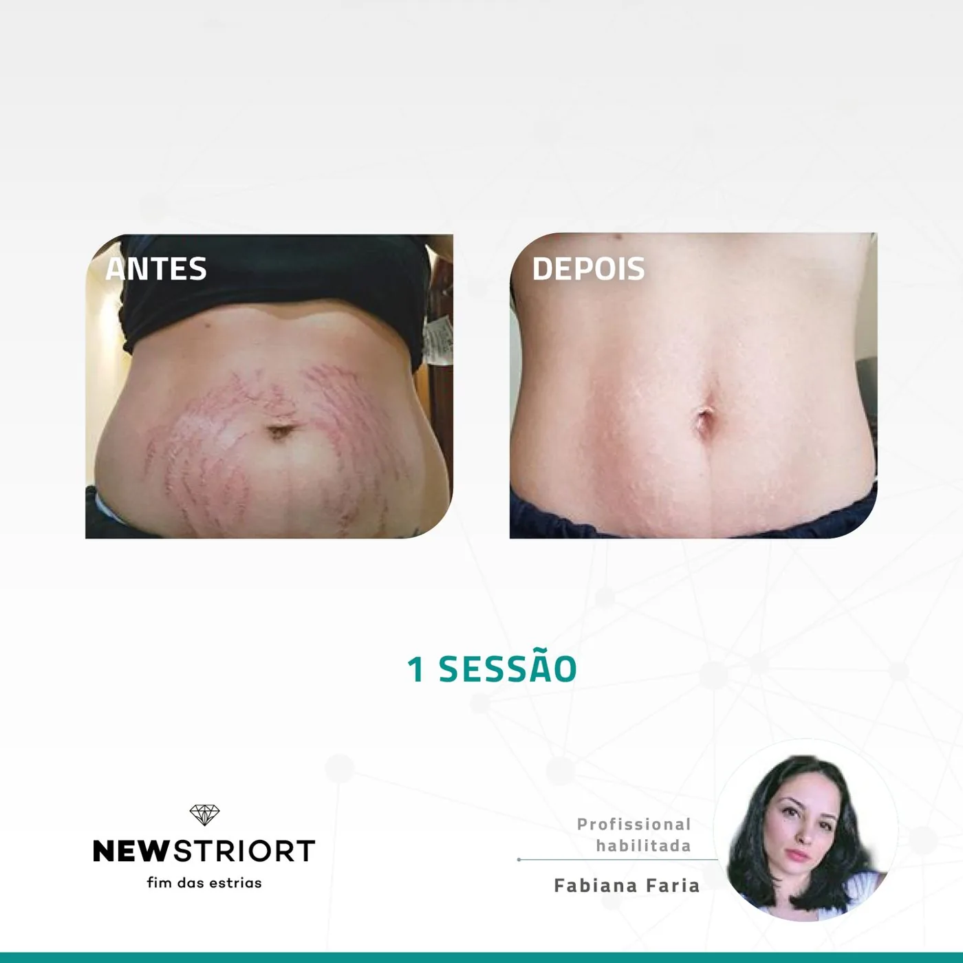Antes e depois — tratamento de estrias por profissional habilitada