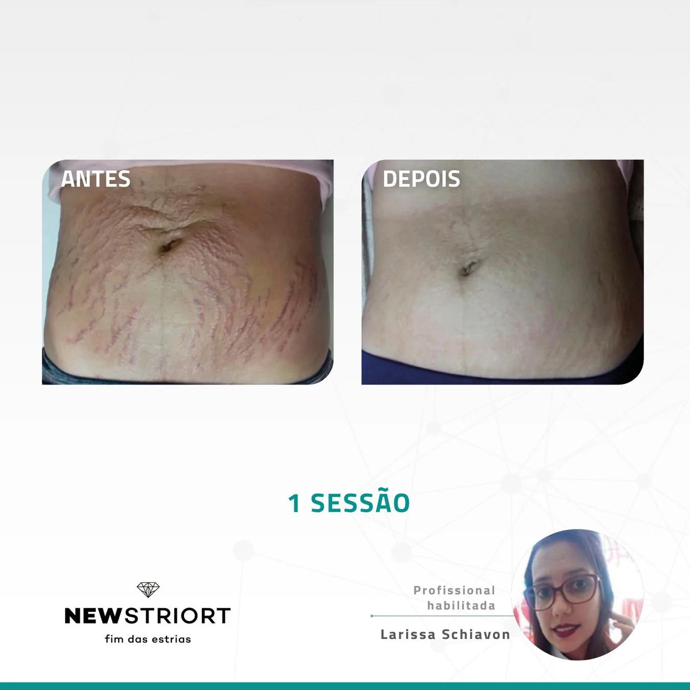 Antes e depois — tratamento de estrias por profissional habilitada