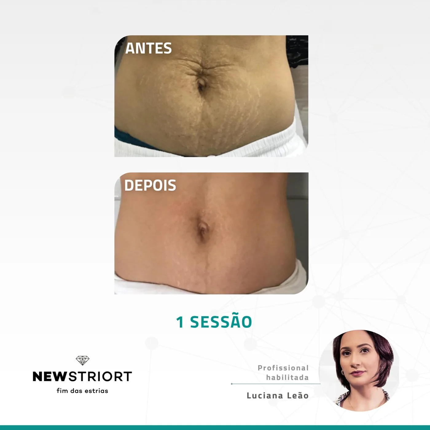 Antes e depois — tratamento de estrias por profissional habilitada