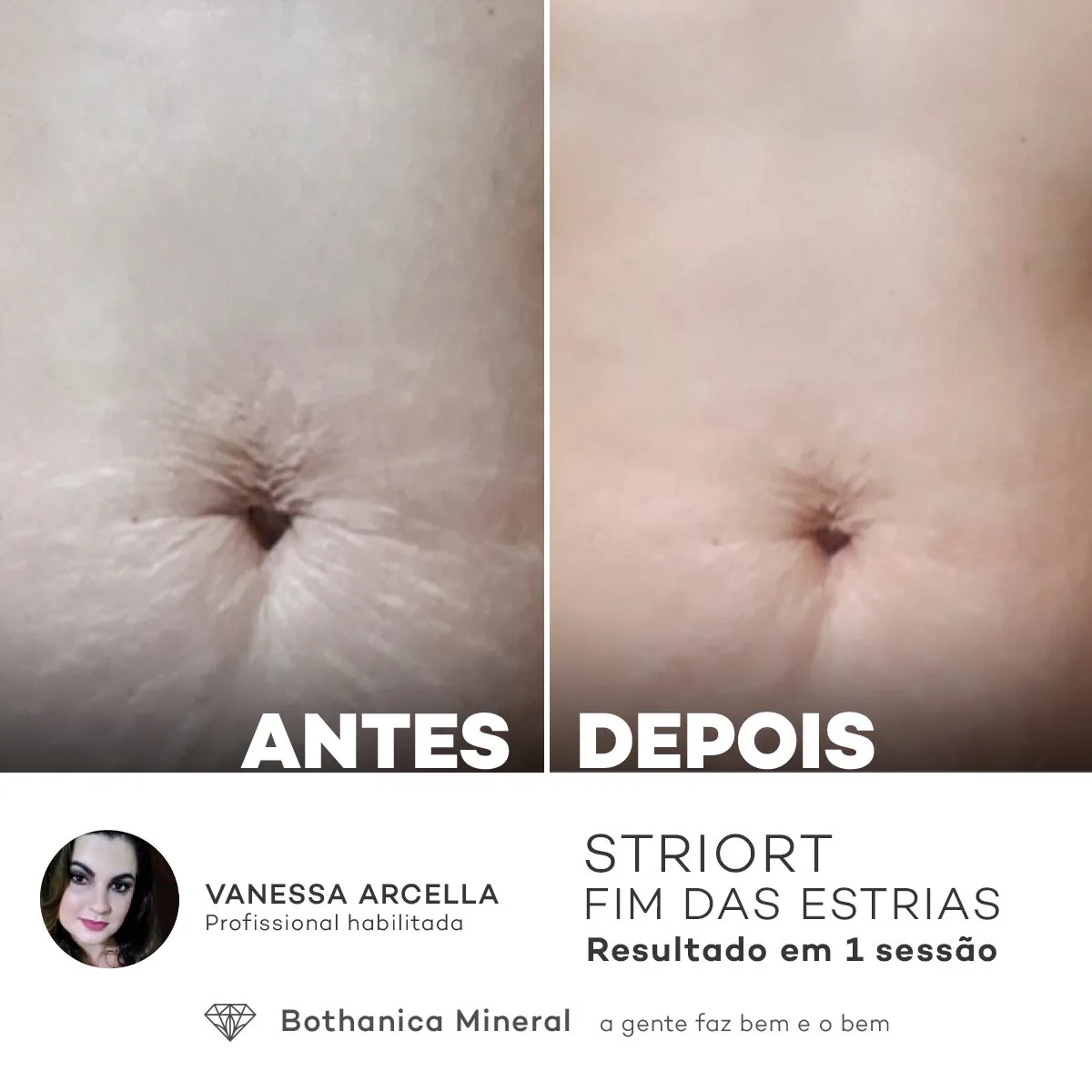 Antes e depois — tratamento de estrias por profissional habilitada