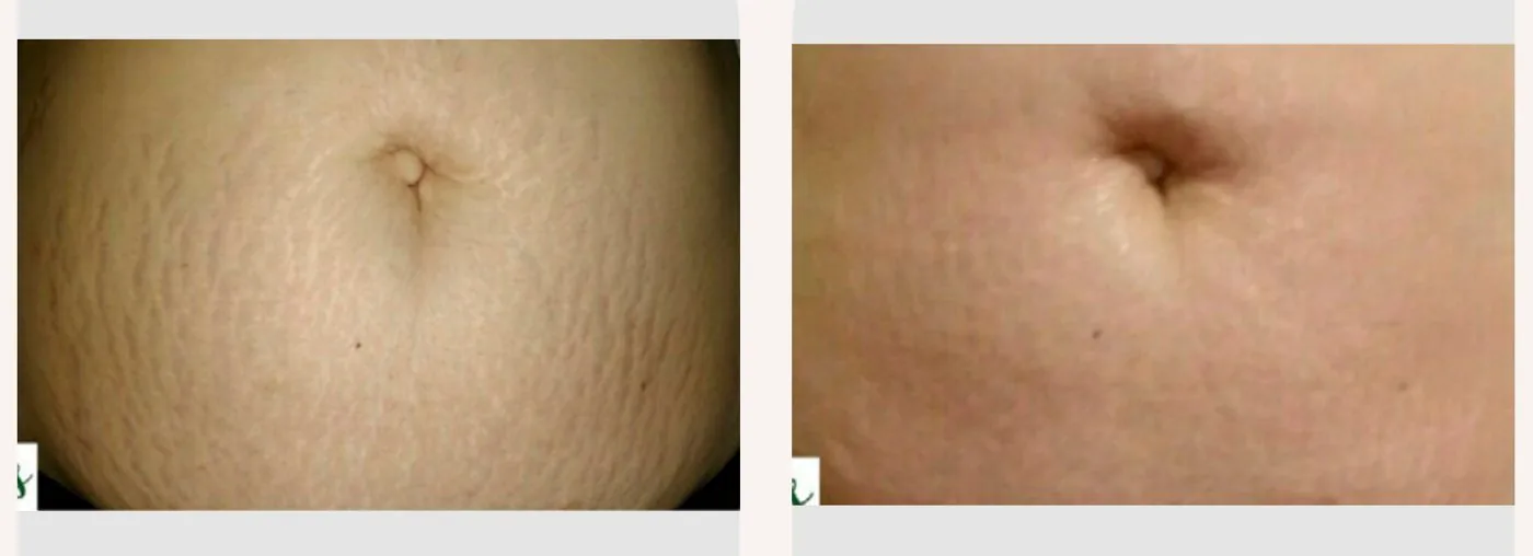 Antes e depois — tratamento de estrias por profissional habilitada