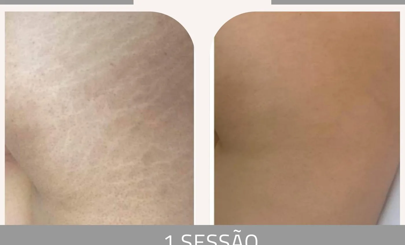 Antes e depois — tratamento de estrias por profissional habilitada