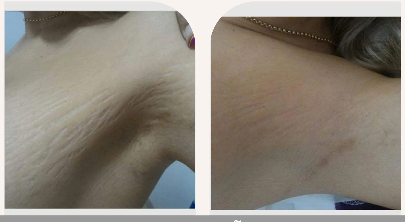 Antes e depois — tratamento de estrias por profissional habilitada