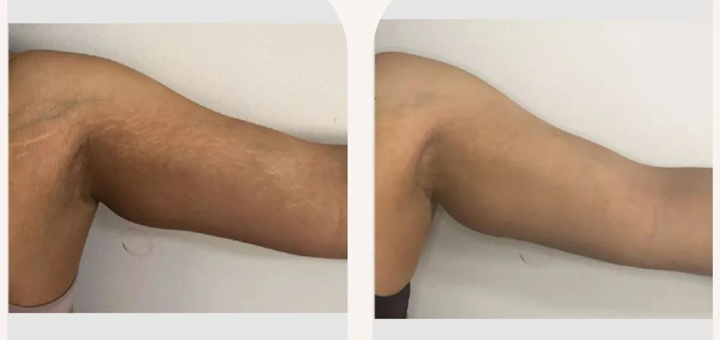 Antes e depois — tratamento de estrias por profissional habilitada