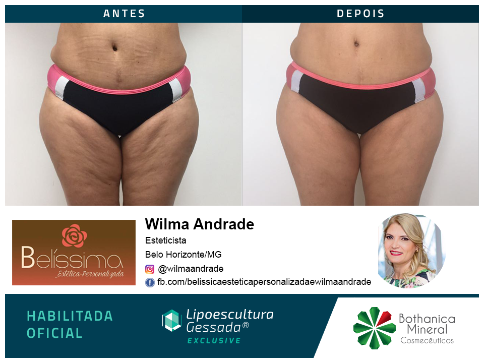 Antes e depois — celulite e gordura localizada por profissional habilitada