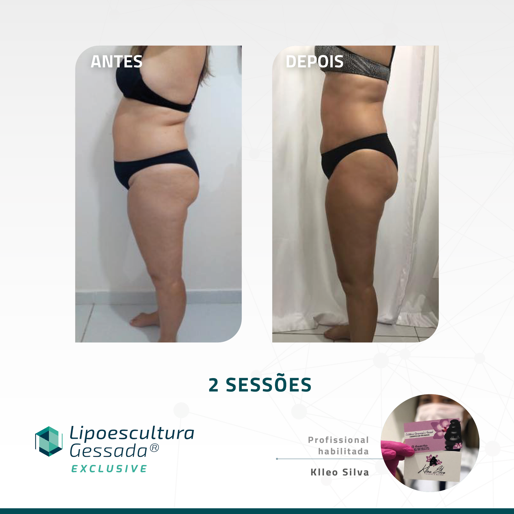 Antes e depois — celulite e gordura localizada por profissional habilitada