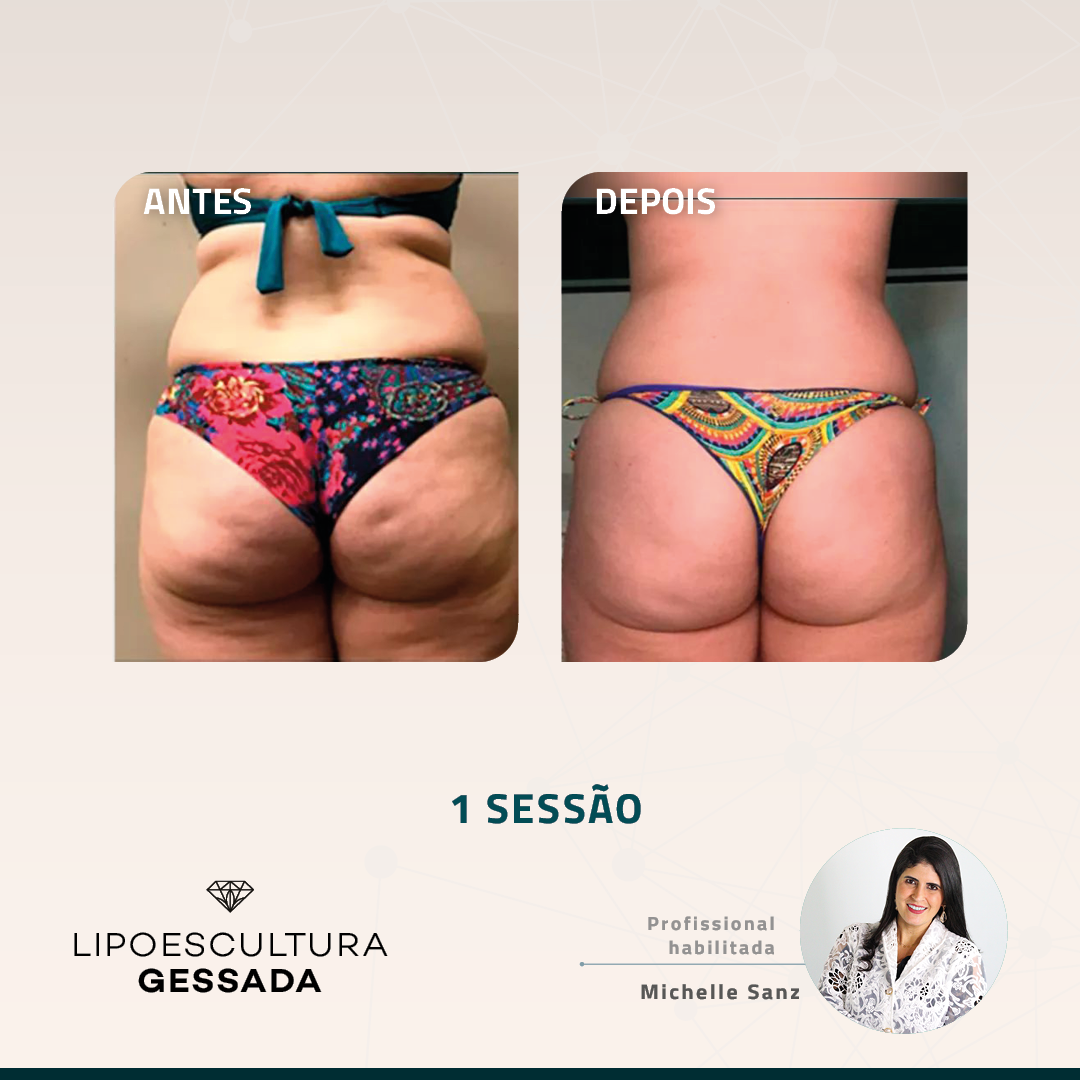 Antes e depois — celulite e gordura localizada por profissional habilitada
