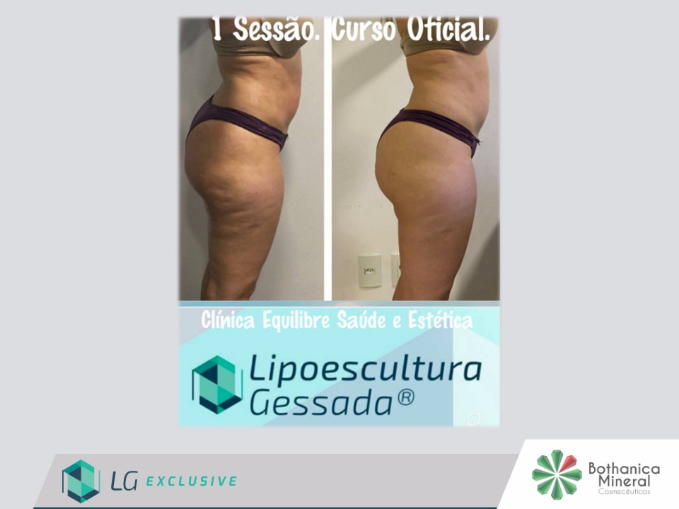 Antes e depois — celulite e gordura localizada por profissional habilitada