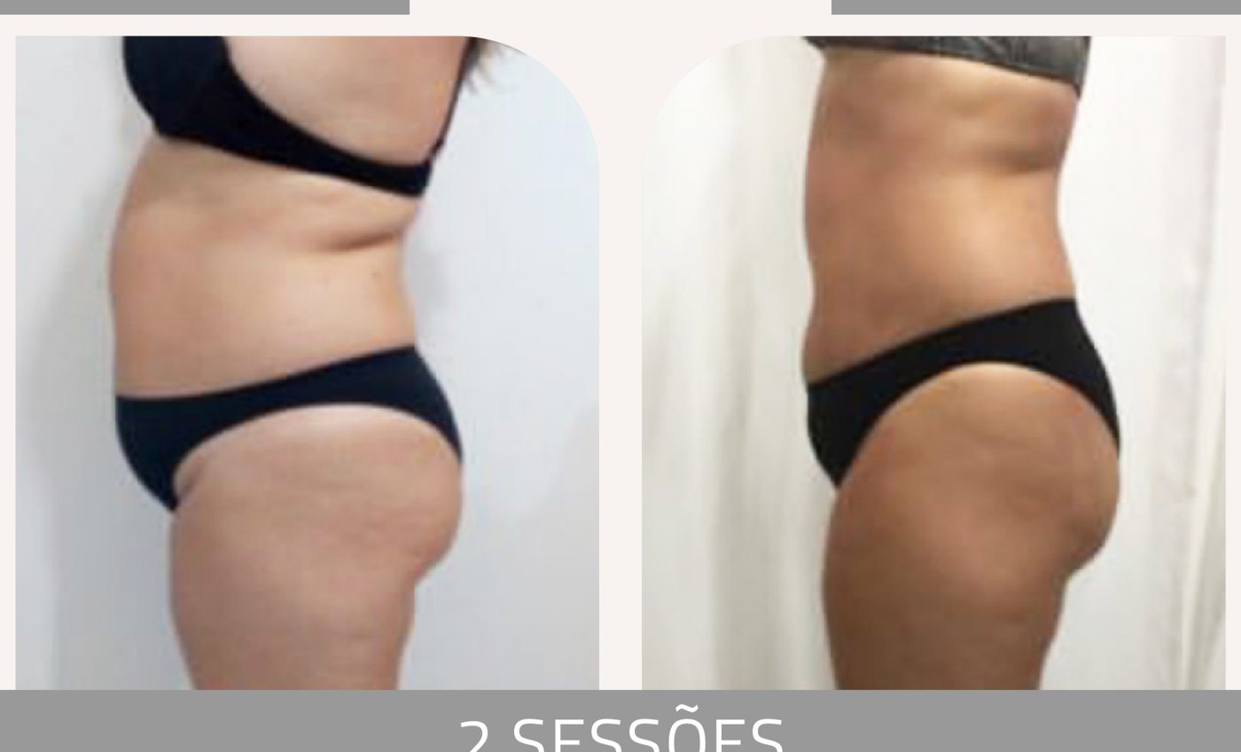 Antes e depois — celulite e gordura localizada por profissional habilitada