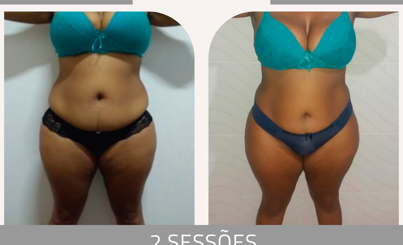 Antes e depois — celulite e gordura localizada por profissional habilitada