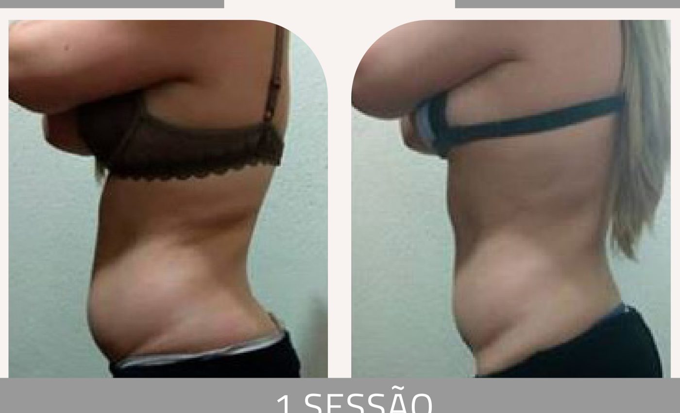 Antes e depois — celulite e gordura localizada por profissional habilitada