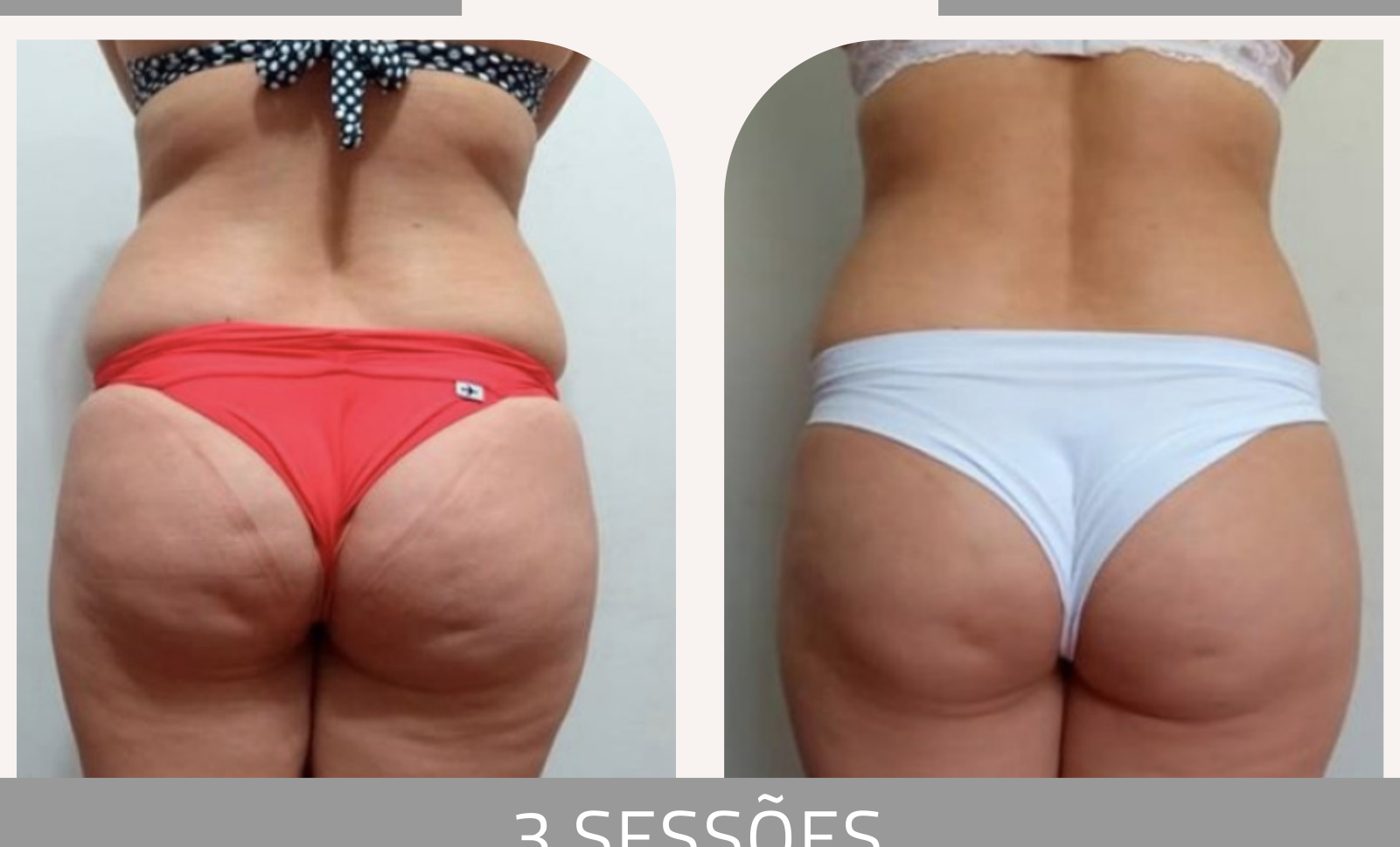 Antes e depois — celulite e gordura localizada por profissional habilitada