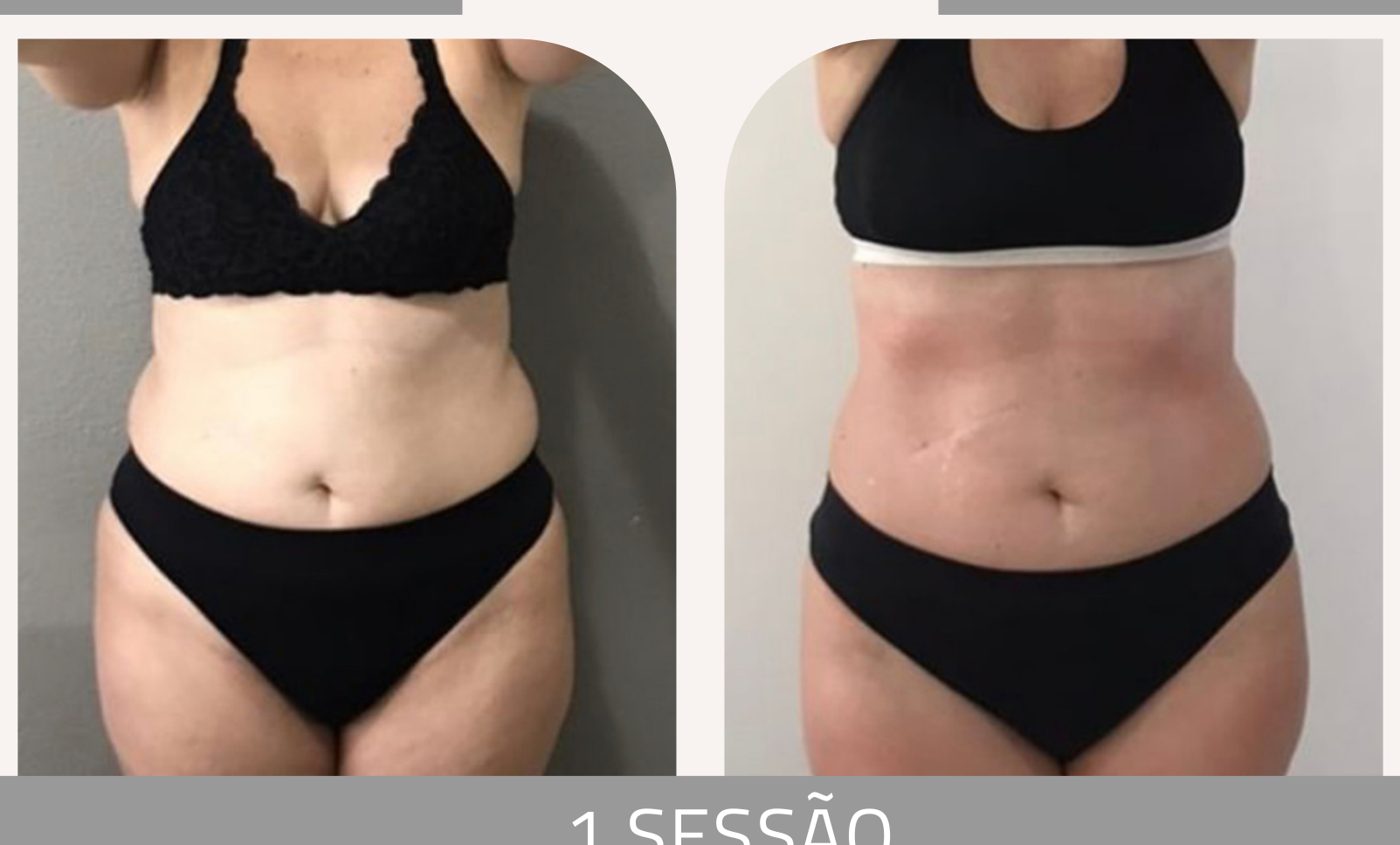 Antes e depois — celulite e gordura localizada por profissional habilitada