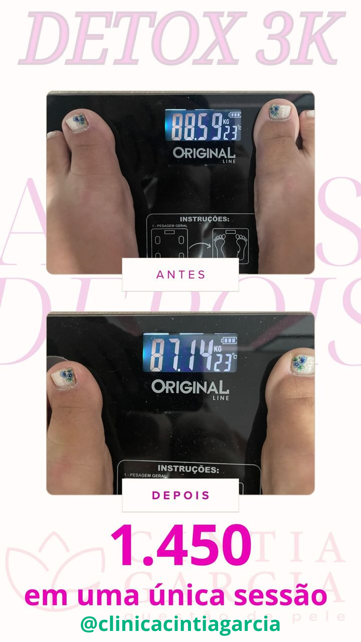 Antes e depois — detox e emagrecimento por profissional habilitada