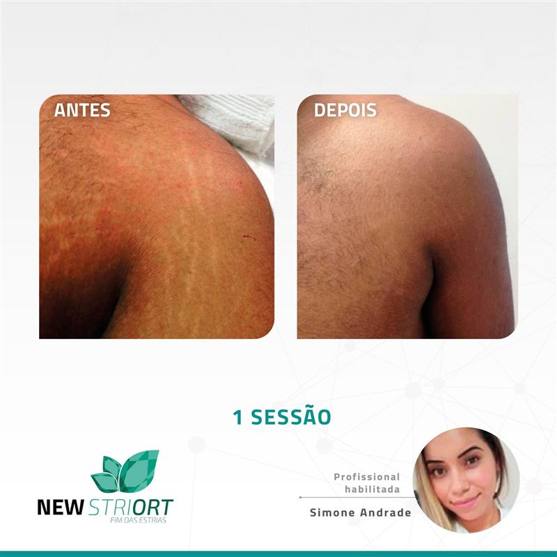 Antes e depois — tratamento de estrias por profissional habilitada
