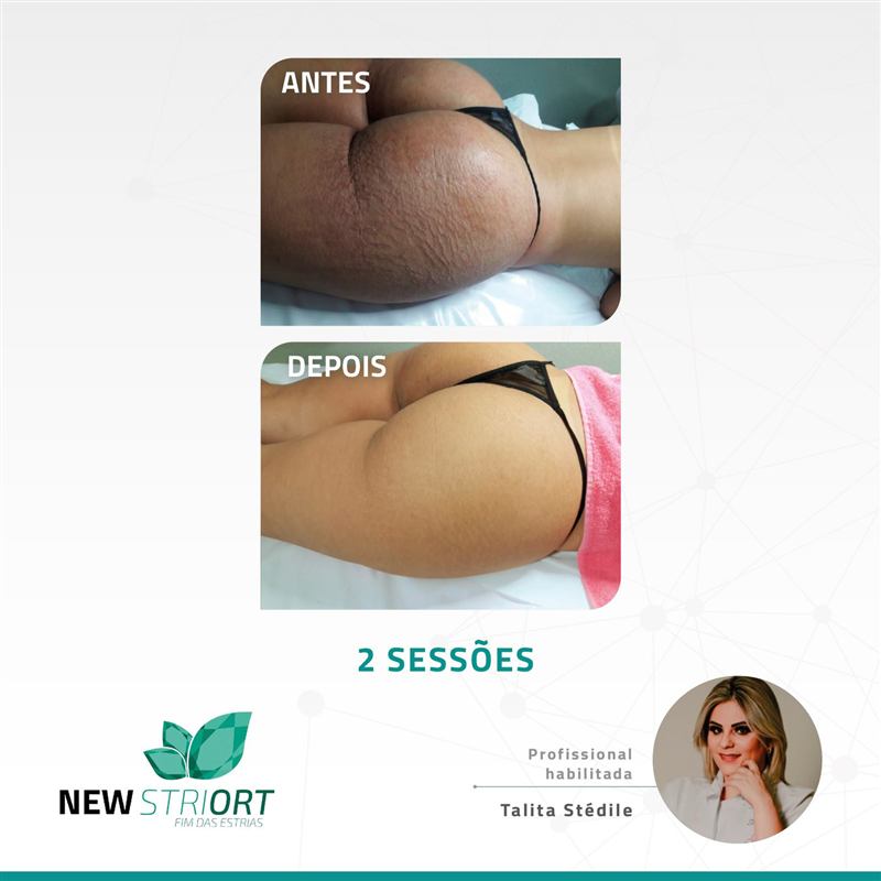 Antes e depois — tratamento de estrias por profissional habilitada