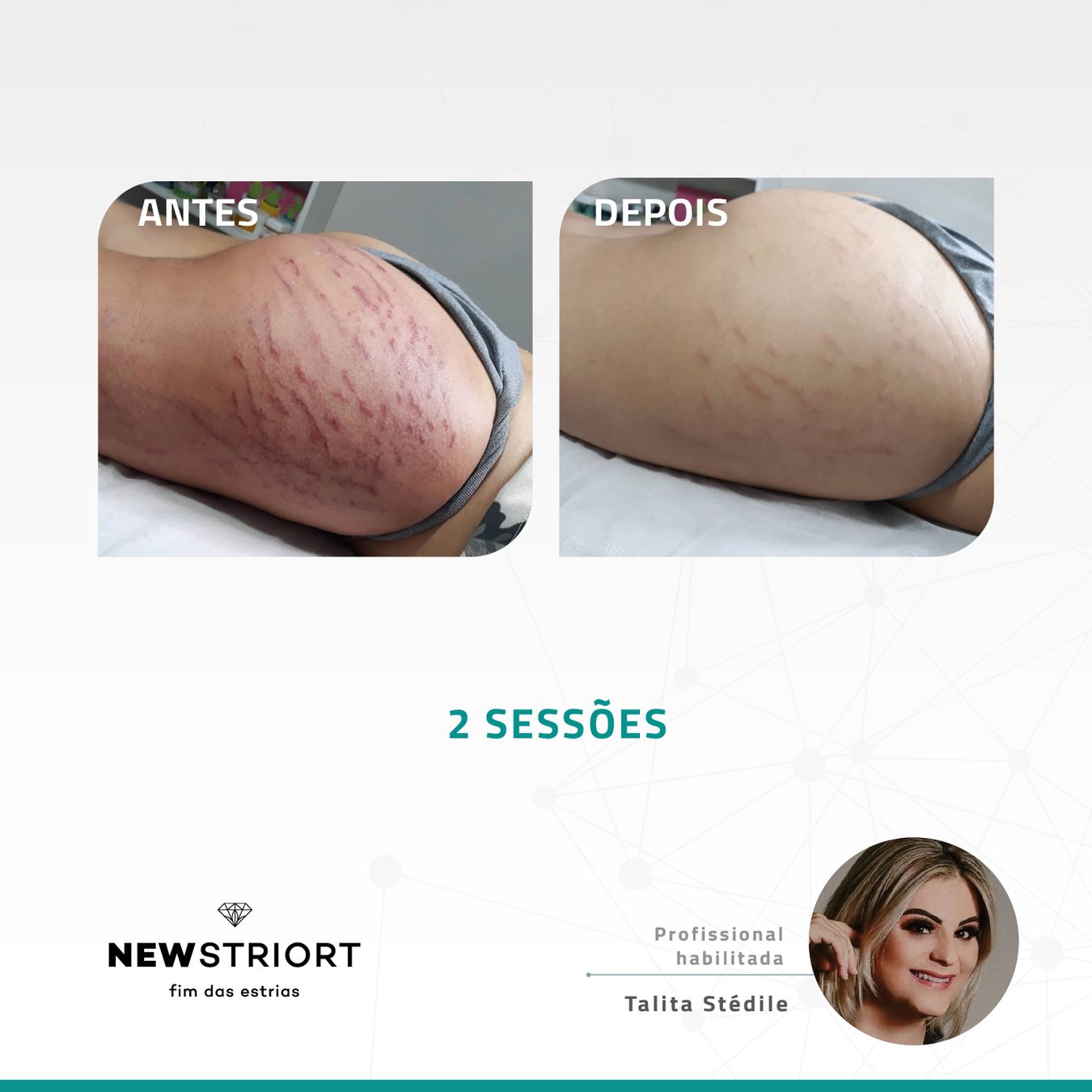 Antes e depois — tratamento de estrias por profissional habilitada