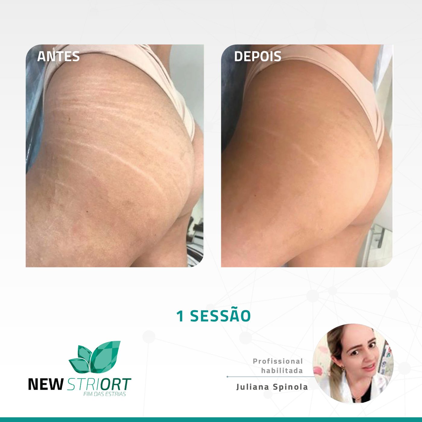 Antes e depois — tratamento de estrias por profissional habilitada