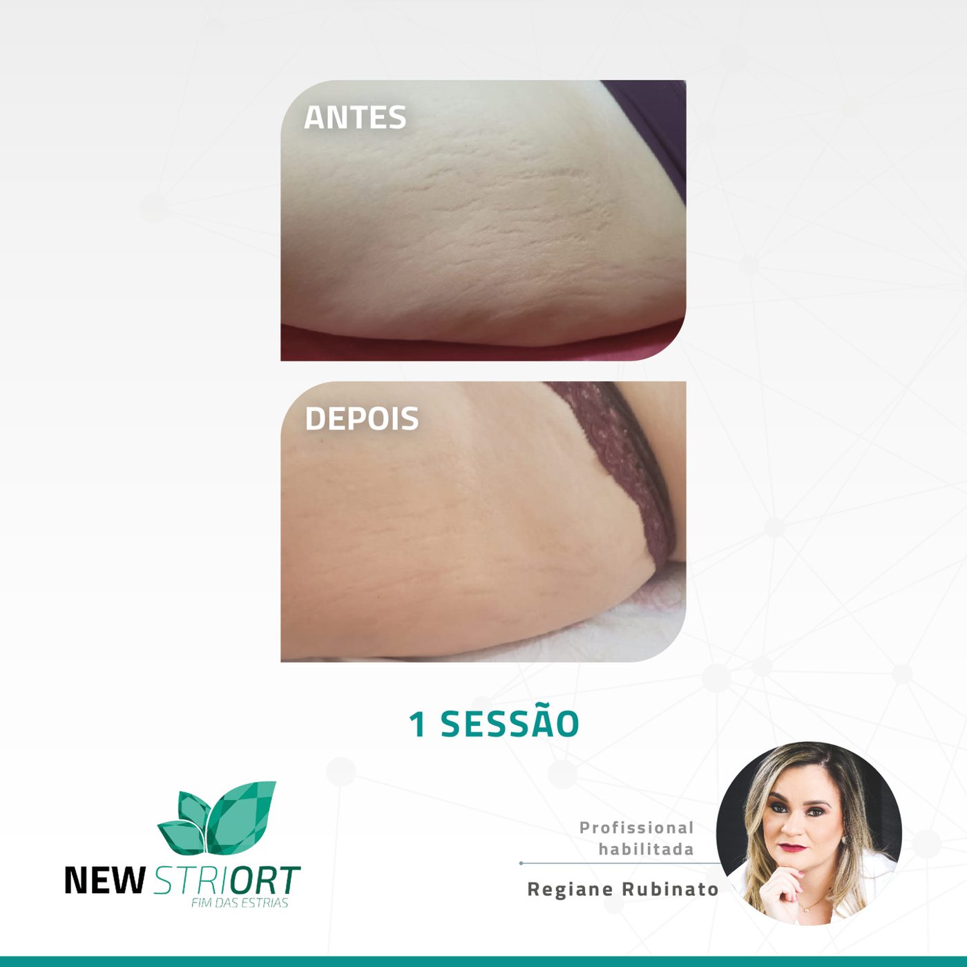 Antes e depois — tratamento de estrias por profissional habilitada