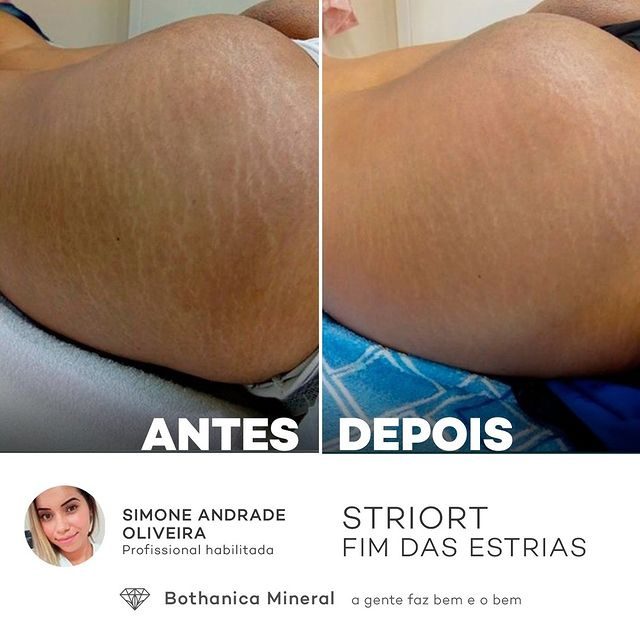 Antes e depois — tratamento de estrias por profissional habilitada