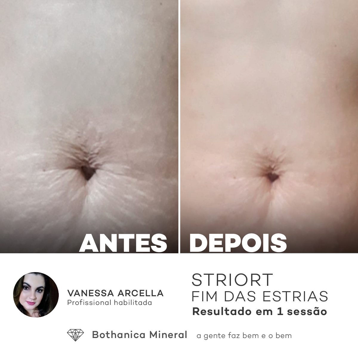 Antes e depois — tratamento de estrias por profissional habilitada
