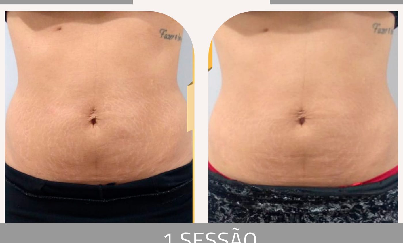 Antes e depois — tratamento de estrias por profissional habilitada