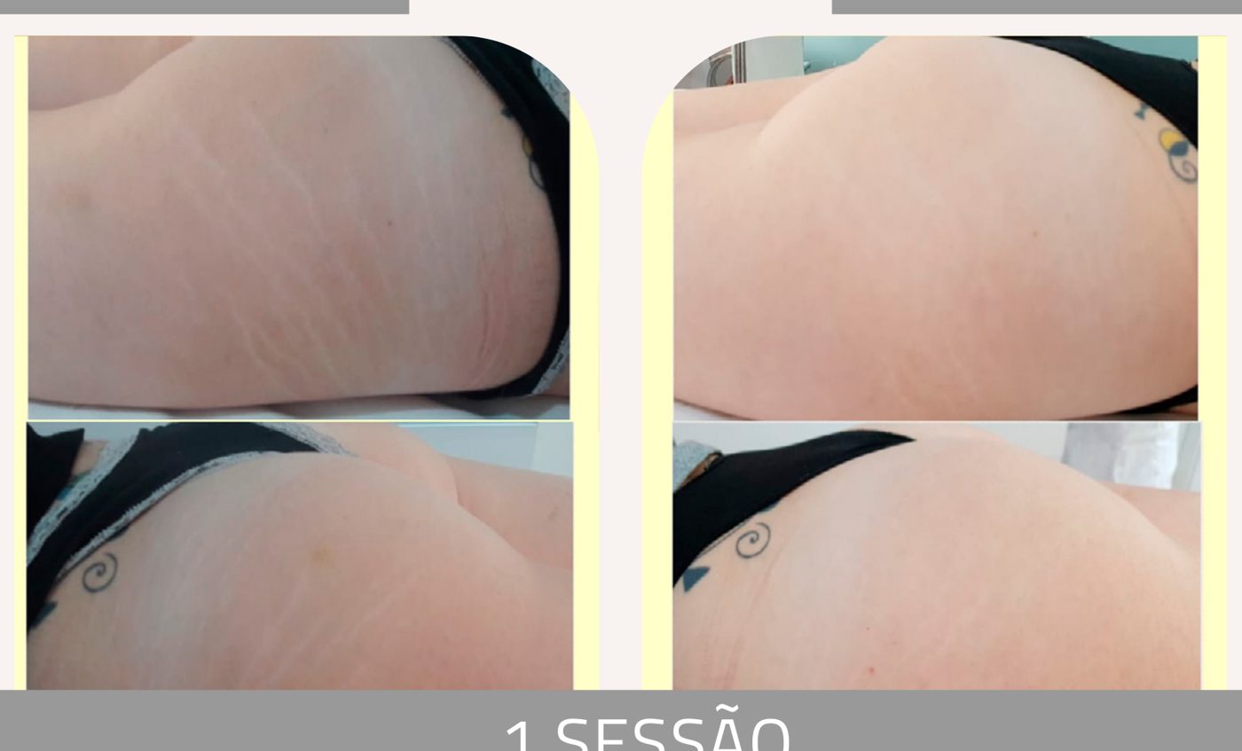 Antes e depois — tratamento de estrias por profissional habilitada