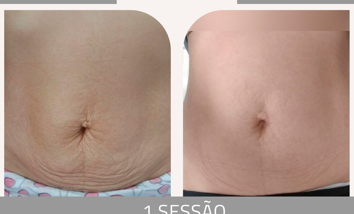 Antes e depois — tratamento de estrias por profissional habilitada