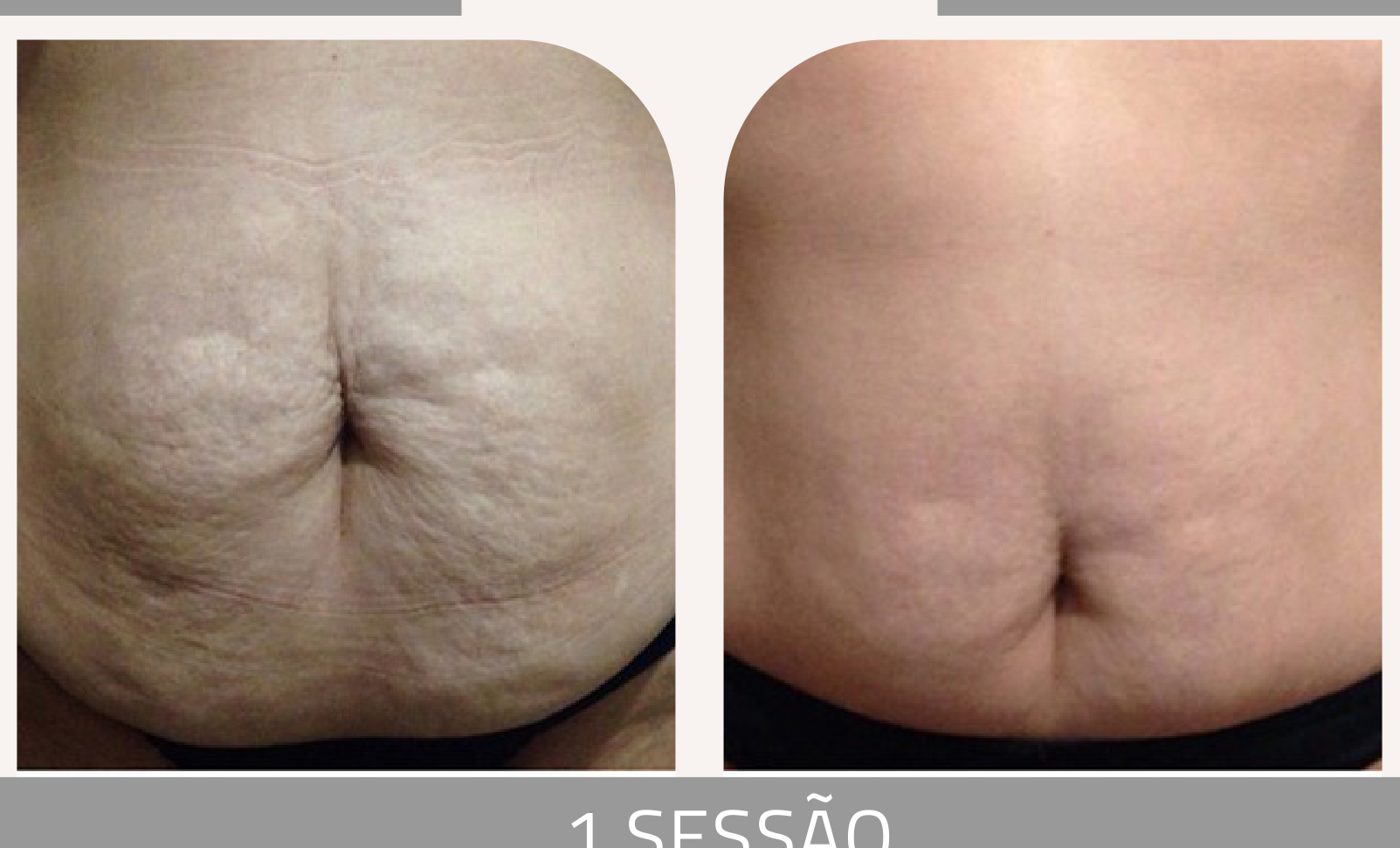 Antes e depois — tratamento de estrias por profissional habilitada