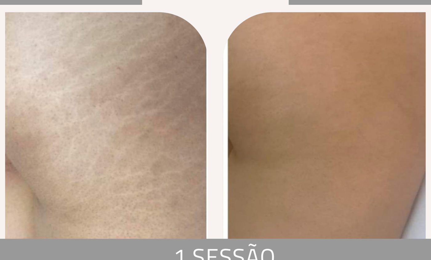Antes e depois — tratamento de estrias por profissional habilitada