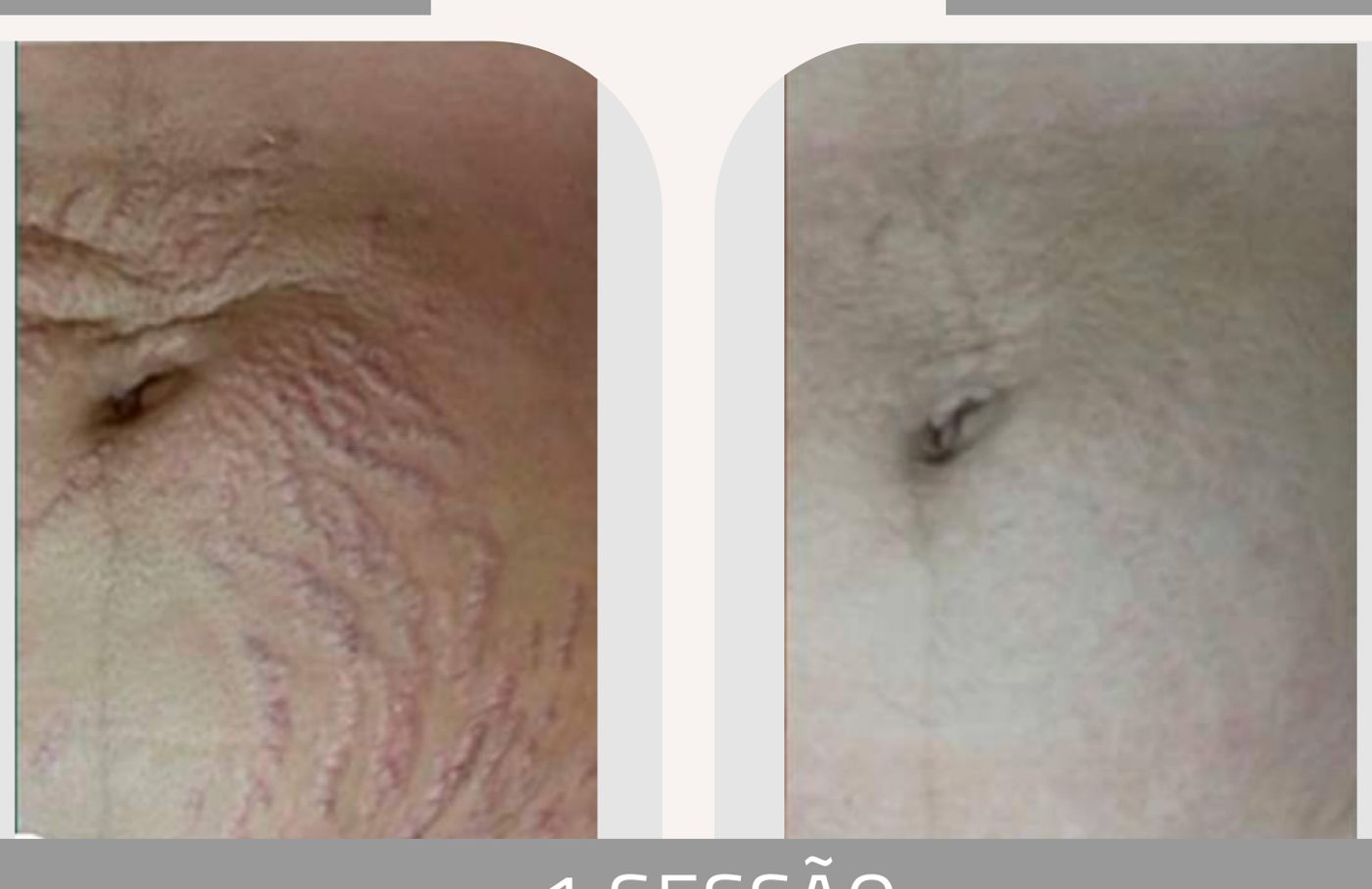 Antes e depois — tratamento de estrias por profissional habilitada